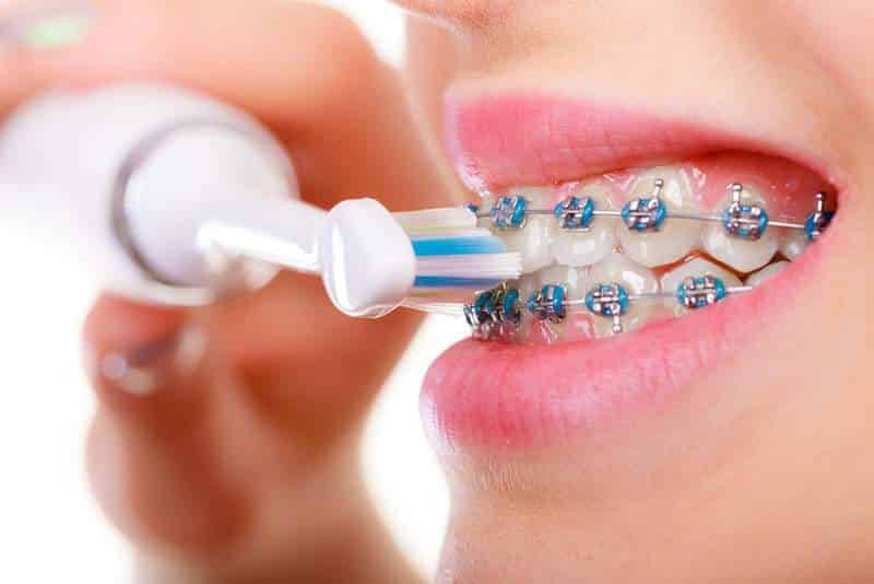 Best Toothbrush for Braces